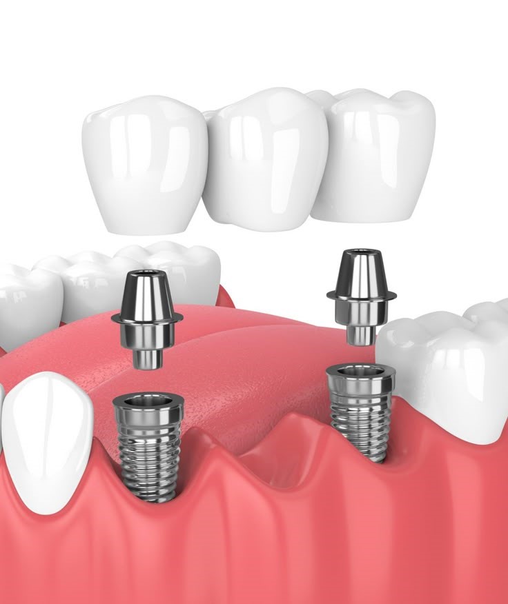 Dental Implants