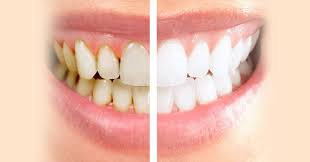 Teeth cleaning and polishing